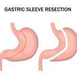 Gastric sleeve resection infographic. Stomach reduction surgery for weight loss. Medicine concept. Vector illustration