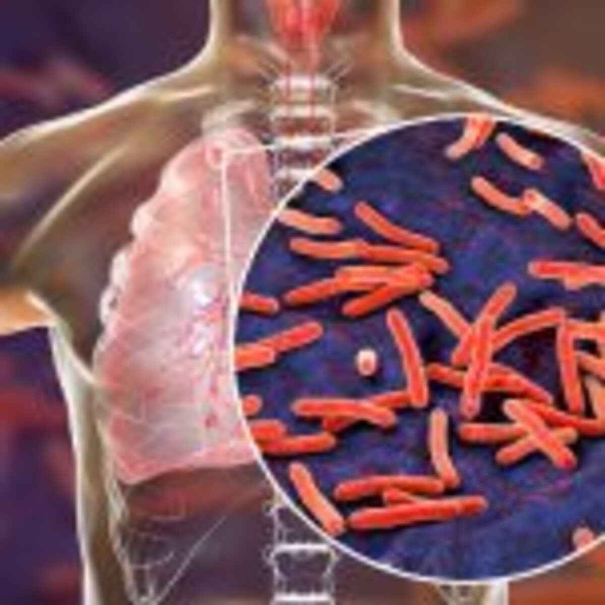 EDITORIAIS-tuberculose-jefferson-almeida-saude-publica
