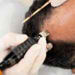 Baltazar Sanabria – Exame Transplante Capilar 2 – Foto Beto Nascimento