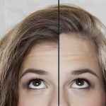 testa grande transplante capilar baltazar sanabria 2