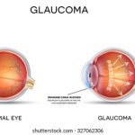 glaucoma 3