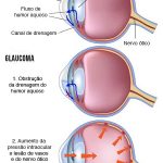 glaucoma2