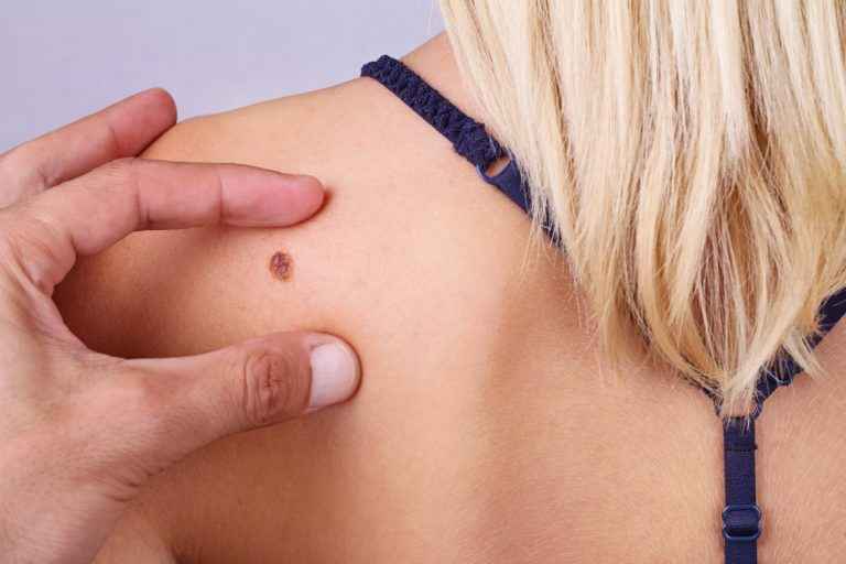 Diagnósticos de câncer de pele melanoma caem mais de 20% no último ano, aponta estudo