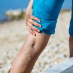 depositphotos_72084451-stock-photo-painful-varicose-veins