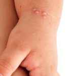 dermato-pediatrica-molusco-contagioso-750×500