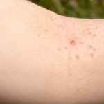 molluscum-contagiosum-picture-id134724539-p3c5nq02g41ll92megjywj6ezgc06v4tn5jxduf8v4