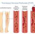 Medical Diagram of Deep Vein Thrombosis at leg area.