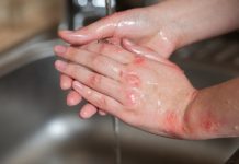 Prevenção no Lar: como evitar acidentes com queimaduras