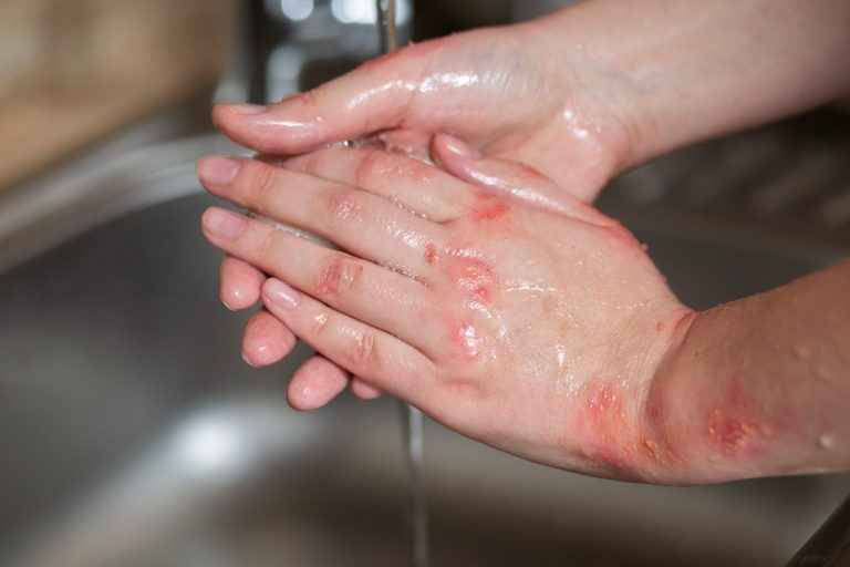 Prevenção no Lar: como evitar acidentes com queimaduras